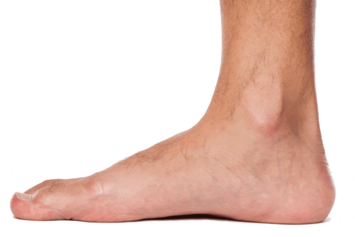 how-to-fix-flat-feet